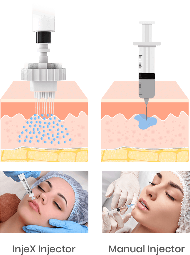 InjeX Injector VS Manual injector InjeX Injector VS Manual injector