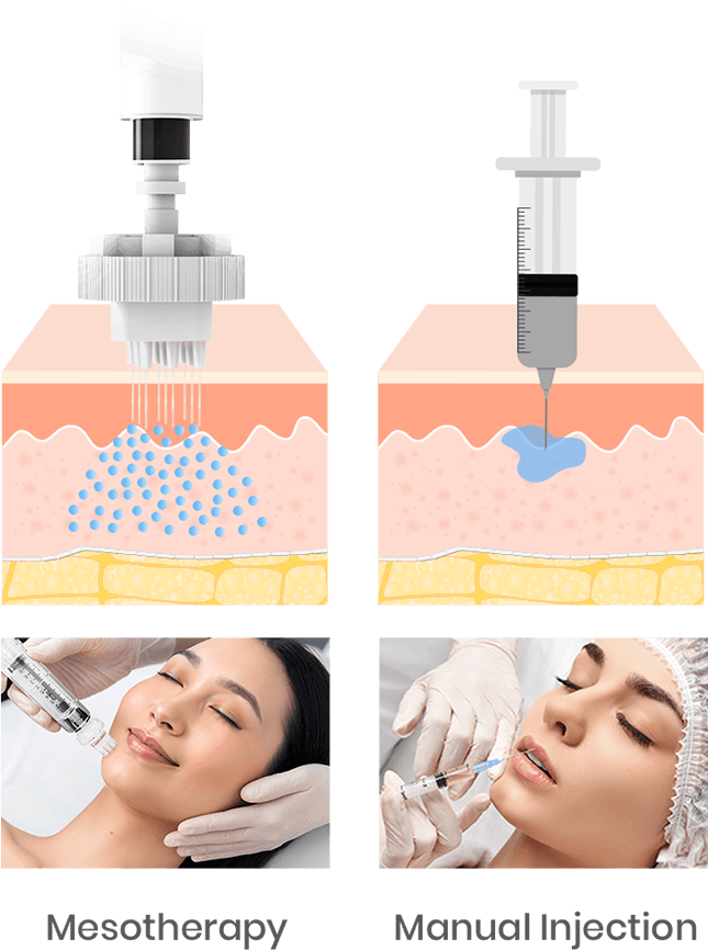 Mesotherapy VS Manual Injection