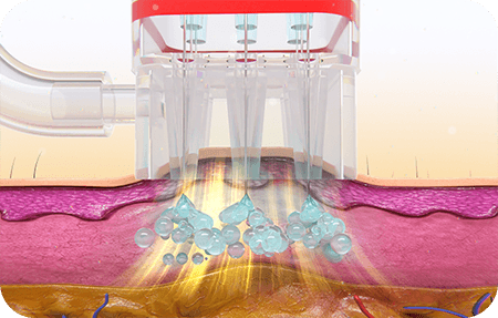 Smart Injection Process - 02 Inject